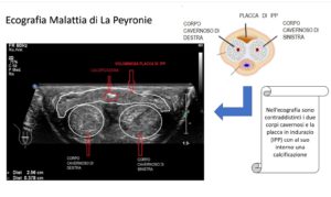 Malattia di La Peyronie: visione ecografica