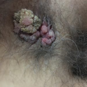 tumore papilloma virus uomo
