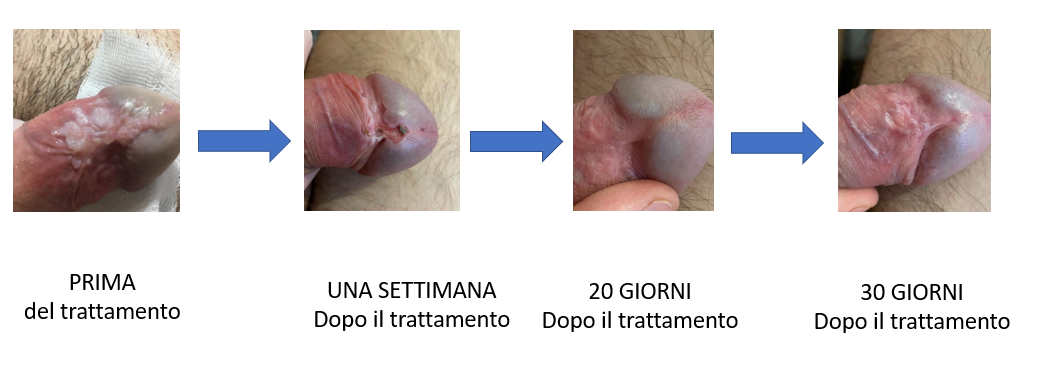 papilloma virus uomo come si manifesta tratament de helmint uman