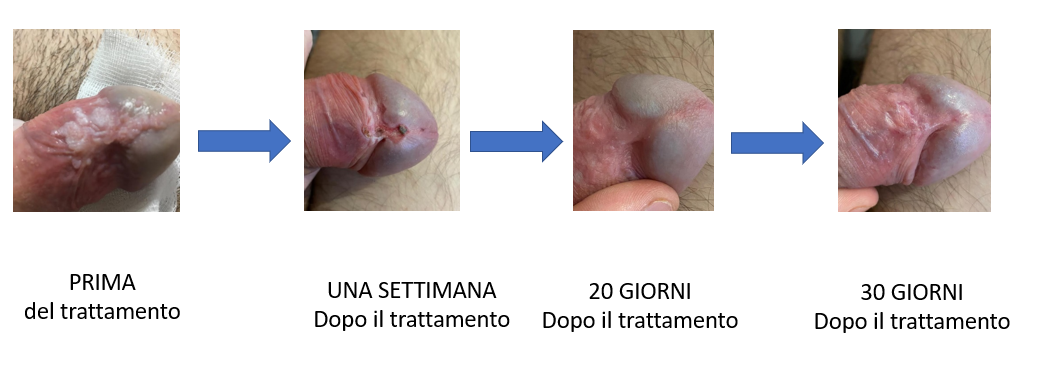 visita per papilloma virus uomo